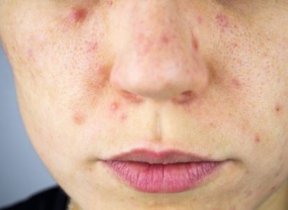 Comment enlever les boutons d'acné et que faire contre l'acné