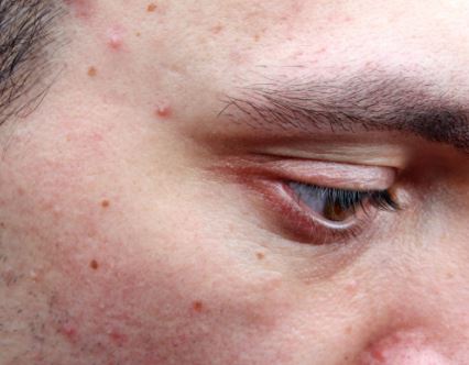 huile essentielle cicatrice acne