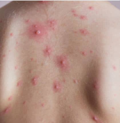 Comment soigner l'acné